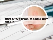 太原哪家牛皮癣医院最好 太原看银屑病哪个医院最好