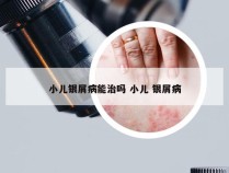 小儿银屑病能治吗 小儿 银屑病