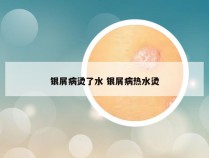 银屑病烫了水 银屑病热水烫