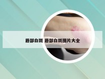 唇部白斑 唇部白斑图片大全