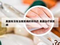 美国有没有治银屑病的特效药 美国治疗银屑病