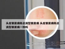 头皮银屑病和点滴型银屑病 头皮银屑病和点滴型银屑病一样吗