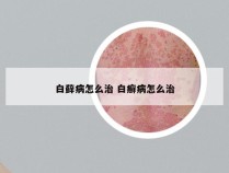 白藓病怎么治 白癣病怎么治