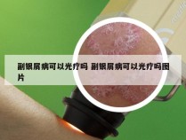 副银屑病可以光疗吗 副银屑病可以光疗吗图片