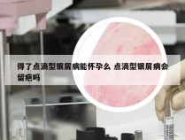 得了点滴型银屑病能怀孕么 点滴型银屑病会留疤吗