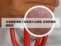 点滴银屑病掉了皮屑是什么颜色 点滴型银屑病脱皮