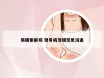 焦膜银屑病 银屑病薄膜现象消退