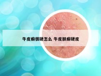 牛皮癣很硬怎么 牛皮肤癣硬皮