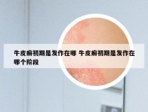 牛皮癣初期是发作在哪 牛皮癣初期是发作在哪个阶段
