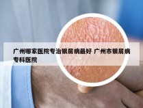 广州哪家医院专治银屑病最好 广州市银屑病专科医院