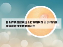 什么样的皮肤病适合打生物制剂 什么样的皮肤病适合打生物制剂治疗