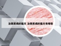 治银屑病的偏方 治银屑病的偏方有哪些
