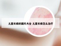 儿童长癣的图片大全 儿童长癣怎么治疗