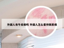 外国人有牛皮癣吗 外国人怎么看待银屑病