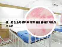 乳汁能否治疗银屑病 银屑病患者哺乳期能擦什么药