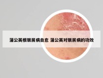 蒲公英根银屑病自愈 蒲公英对银屑病的功效