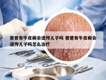 爸爸有牛皮癣会遗传儿子吗 爸爸有牛皮癣会遗传儿子吗怎么治疗