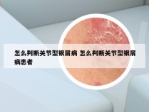 怎么判断关节型银屑病 怎么判断关节型银屑病患者
