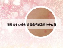 银屑病手心燥热 银屑病手脚发热吃什么药