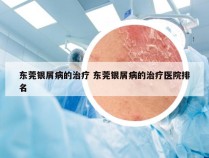 东莞银屑病的治疗 东莞银屑病的治疗医院排名