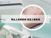 睾丸上有银屑病 蛋蛋上银屑病
