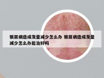 银屑病造成发量减少怎么办 银屑病造成发量减少怎么办能治好吗