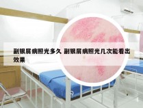 副银屑病照光多久 副银屑病照光几次能看出效果