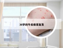 30岁的牛皮癣易复发
