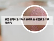 板蓝根可以治疗牛皮癣银屑病 板蓝根治疗银屑病吗
