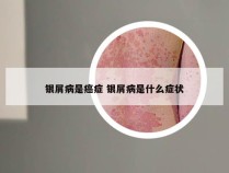 银屑病是癌症 银屑病是什么症状