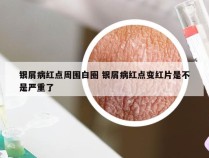 银屑病红点周围白圈 银屑病红点变红片是不是严重了