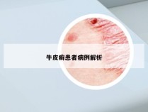 牛皮癣患者病例解析