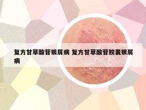 复方甘草酸苷银屑病 复方甘草酸苷胶囊银屑病