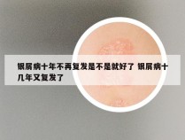 银屑病十年不再复发是不是就好了 银屑病十几年又复发了