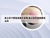 身上长个两包说是牛皮癣 身上长牛皮肤癣怎么办