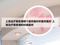 上海治疗银屑病哪个医院最好的医院最好 上海治疗银屑病的权威医院