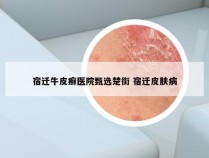 宿迁牛皮癣医院甄选楚街 宿迁皮肤病