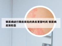 银屑病进行期皮损处的表皮更替时间 银屑病皮损形态