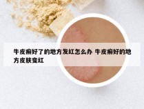 牛皮癣好了的地方发红怎么办 牛皮癣好的地方皮肤变红