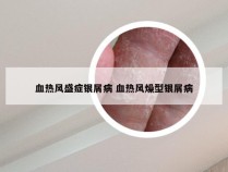 血热风盛症银屑病 血热风燥型银屑病