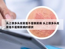 头上很多头皮屑是不是银屑病 头上很多头皮屑是不是银屑病的症状