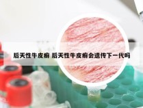 后天性牛皮癣 后天性牛皮癣会遗传下一代吗
