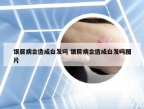 银屑病会造成白发吗 银屑病会造成白发吗图片