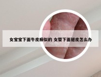 女宝宝下面牛皮癣似的 女婴下面褪皮怎么办