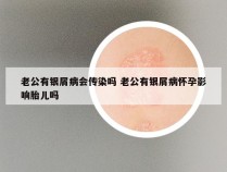 老公有银屑病会传染吗 老公有银屑病怀孕影响胎儿吗