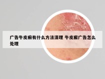 广告牛皮癣有什么方法清理 牛皮廨广告怎么处理