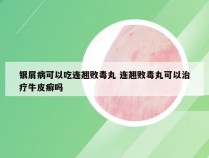 银屑病可以吃连翘败毒丸 连翘败毒丸可以治疗牛皮癣吗