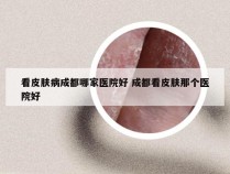 看皮肤病成都哪家医院好 成都看皮肤那个医院好