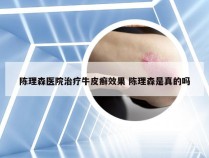 陈理森医院治疗牛皮癣效果 陈理森是真的吗