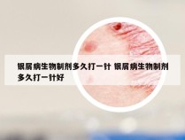 银屑病生物制剂多久打一针 银屑病生物制剂多久打一针好